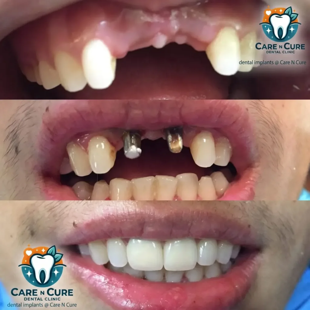 dental implants in islamabad before & After @ Care N Cure Dental Clinic Islamabad-3