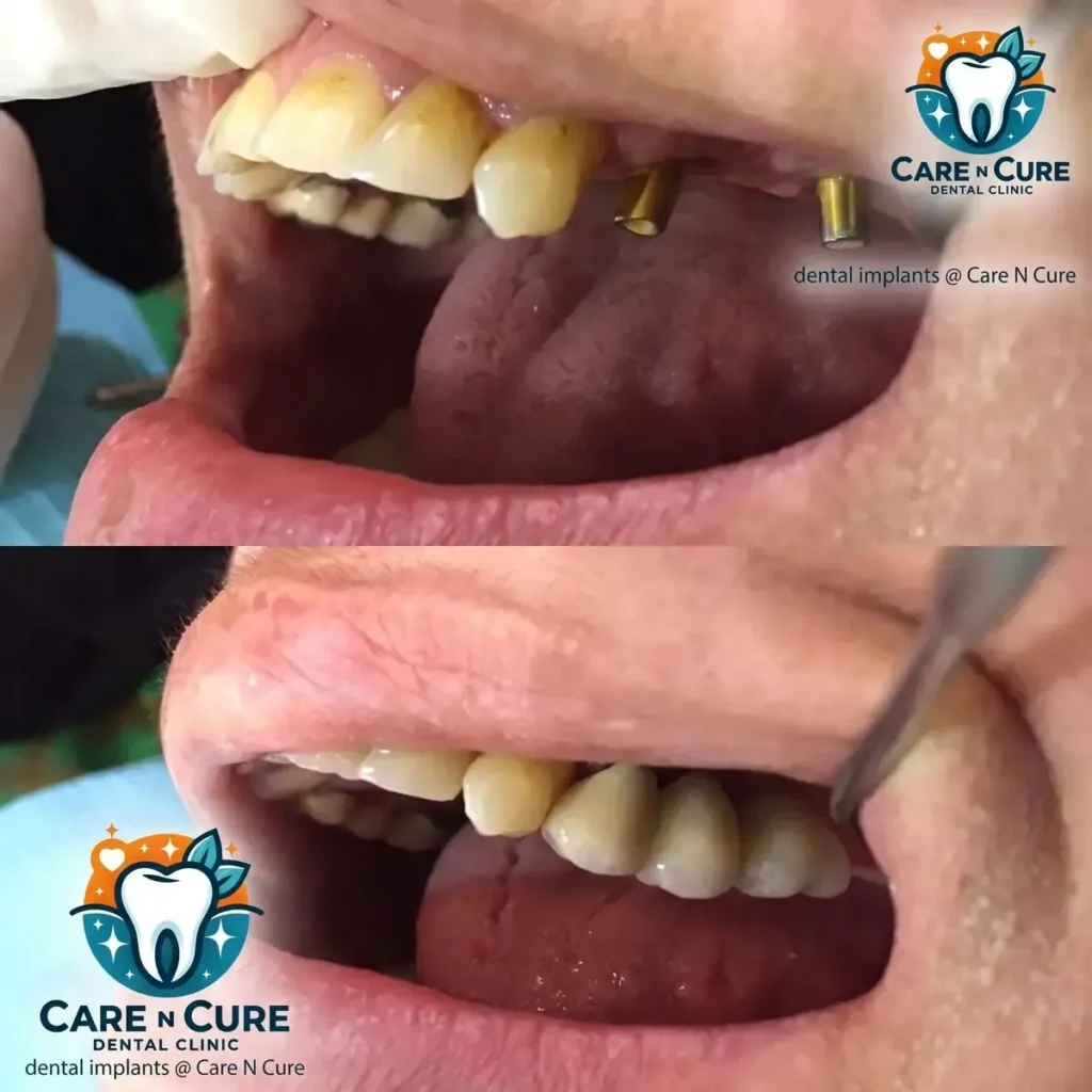 dental implants in islamabad before & After @ Care N Cure Dental Clinic Islamabad-2