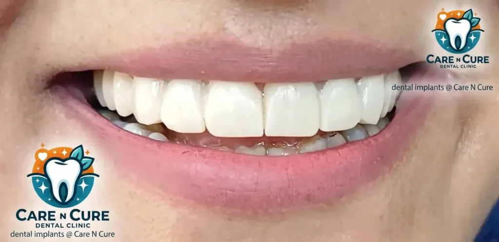 dental implants in islamabad before & After @ Care N Cure Dental Clinic Islamabad-5
