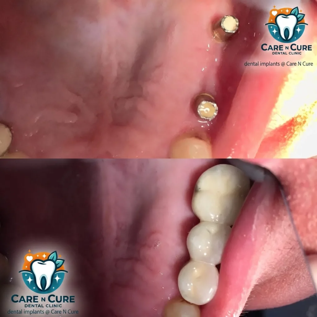 dental implant in islamabad before & after at Care N Cure Dental Clinic Islamabad