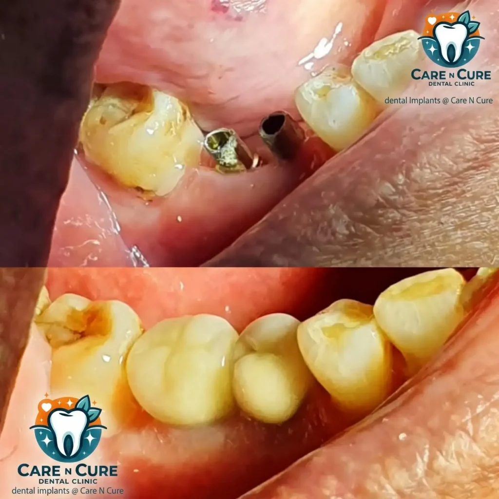 dental implants in islamabad before & After @ Care N Cure Dental Clinic Islamabad-4