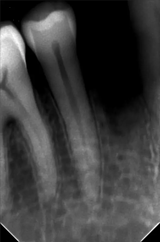 dental implants in islamabad before & after periaical Xray 1