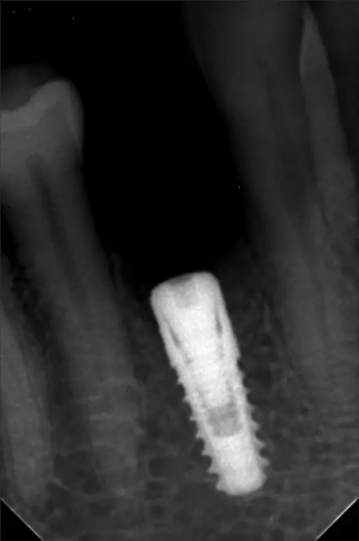 dental implants in islamabad before & after periaical Xray 2